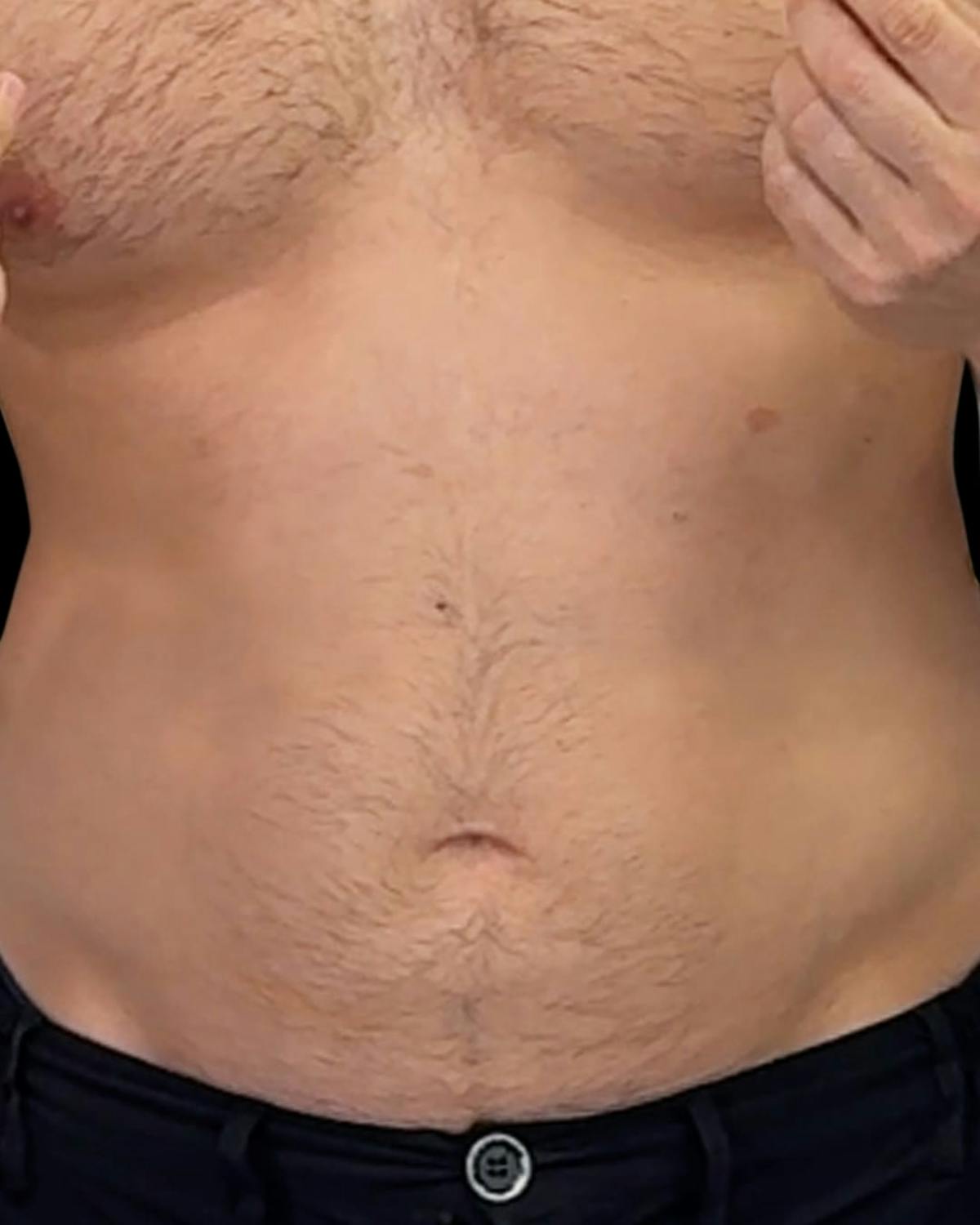 Before & Afters Before & After Gallery - Patient 148423 - Image 1