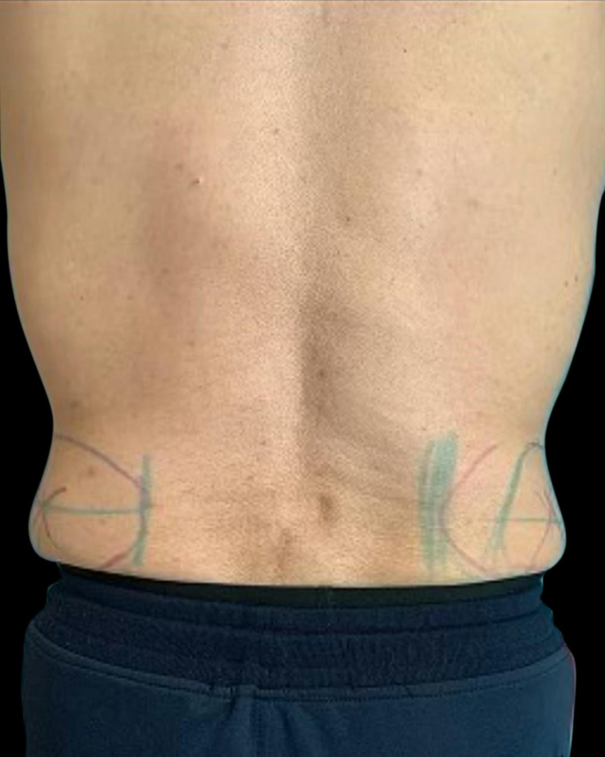 Before & Afters Before & After Gallery - Patient 925557 - Image 2