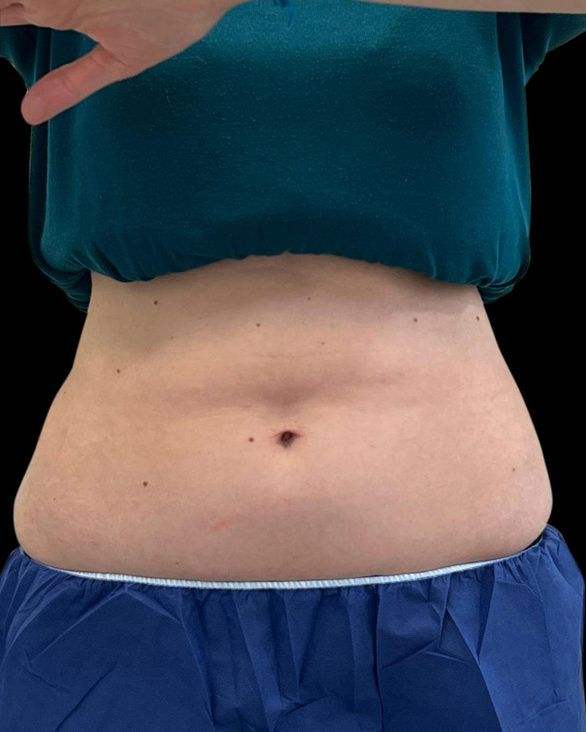 Before & Afters Before & After Gallery - Patient 127491 - Image 1