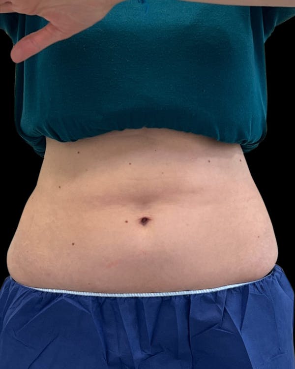 Before & Afters Before & After Gallery - Patient 127491 - Image 1