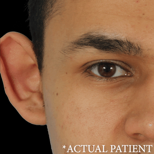 GIFs Before & After Gallery - Patient 379942 - Image 1