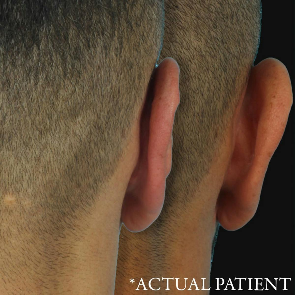 Before & Afters Before & After Gallery - Patient 385215 - Image 1