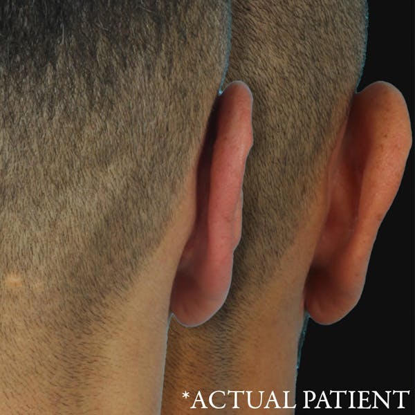 Before & Afters Before & After Gallery - Patient 385215 - Image 1