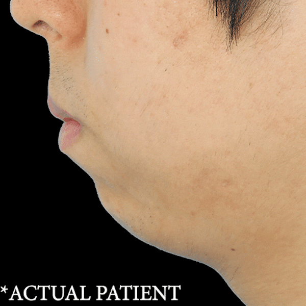 GIFs Before & After Gallery - Patient 244144 - Image 1