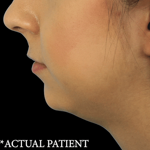 GIFs Before & After Gallery - Patient 384617 - Image 1
