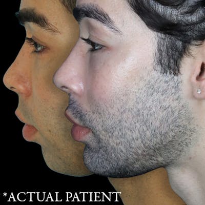 Before & Afters Before & After Gallery - Patient 272186 - Image 1
