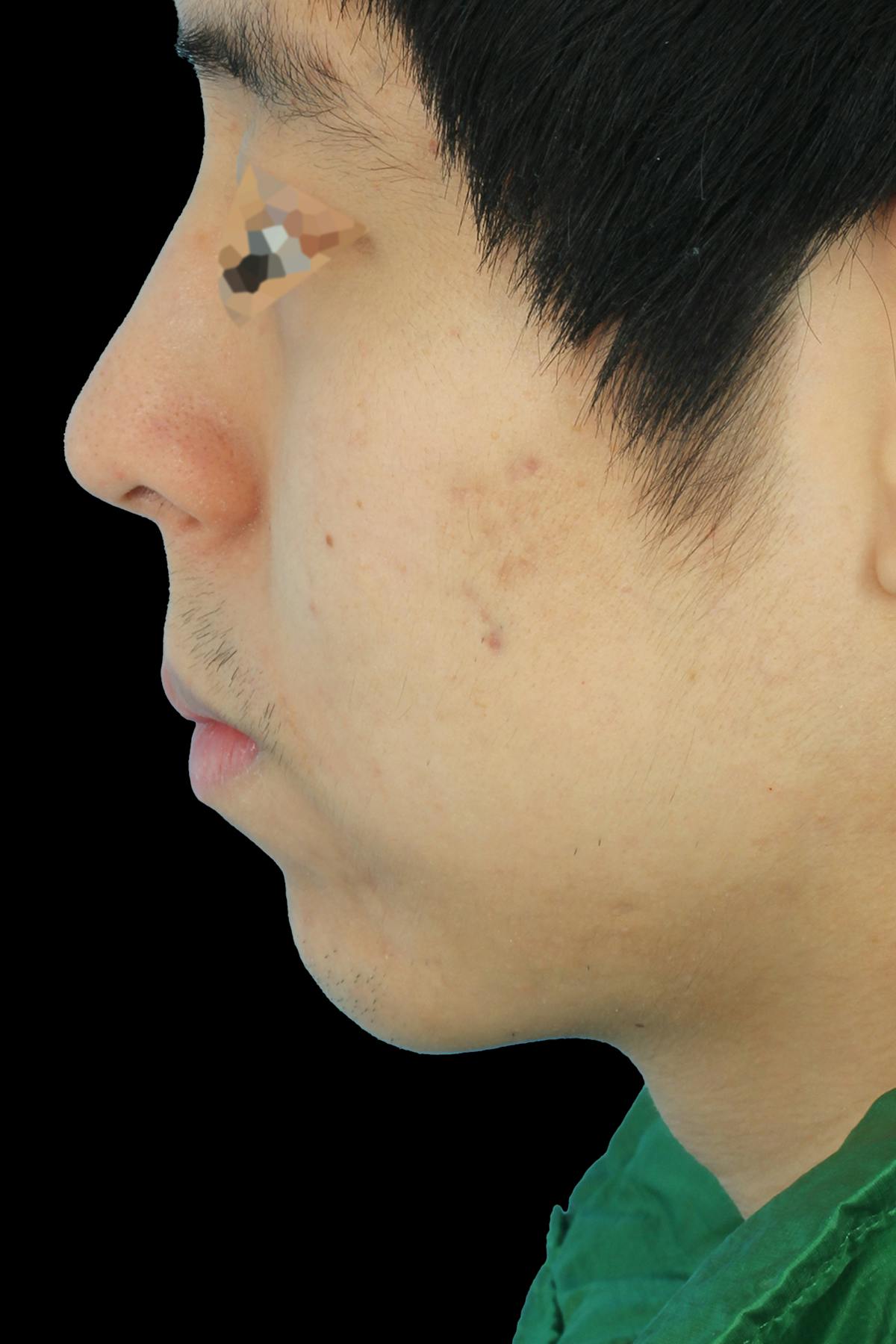Before & Afters Before & After Gallery - Patient 336873 - Image 2