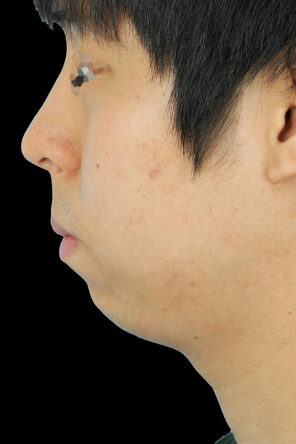 Before & Afters Before & After Gallery - Patient 336873 - Image 1