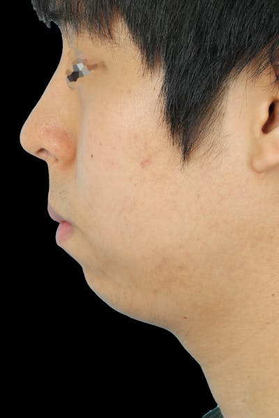 Before & Afters Before & After Gallery - Patient 336873 - Image 1