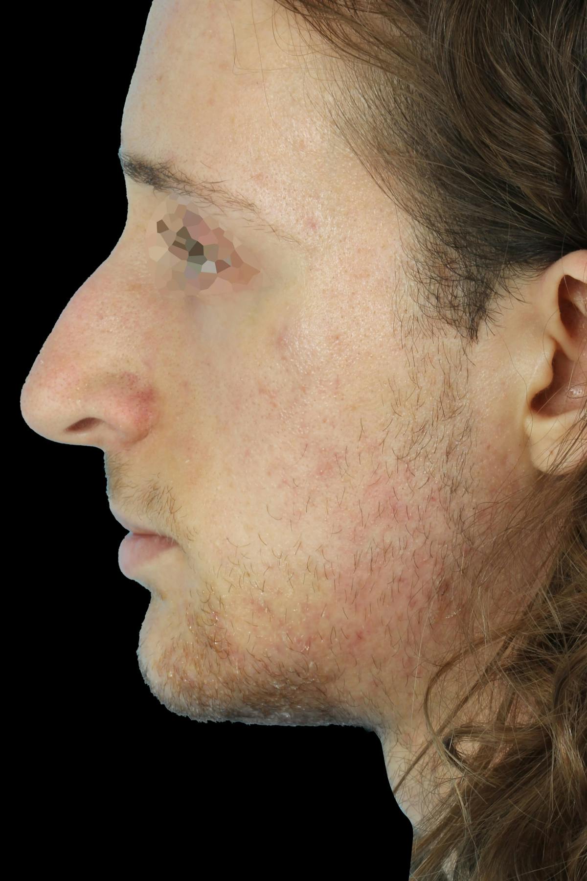 Before & Afters Before & After Gallery - Patient 149933 - Image 2