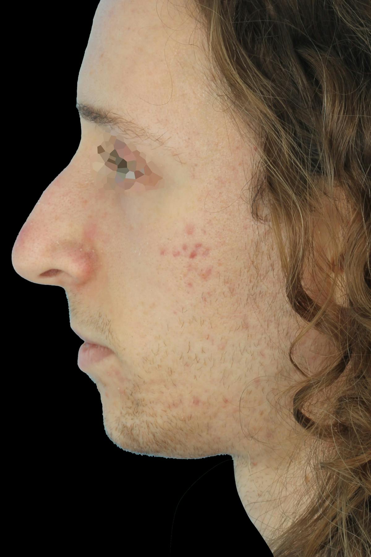 Before & Afters Before & After Gallery - Patient 149933 - Image 1