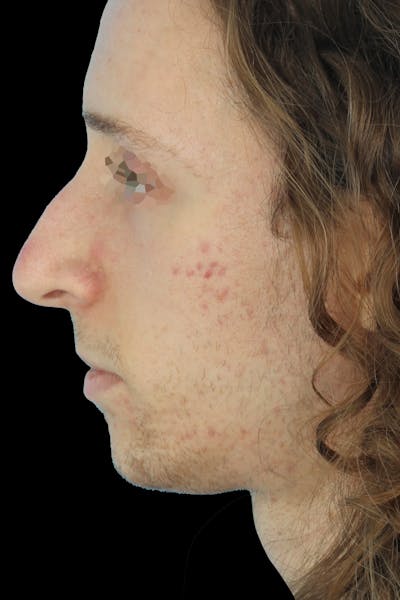 Before & Afters Before & After Gallery - Patient 149933 - Image 1