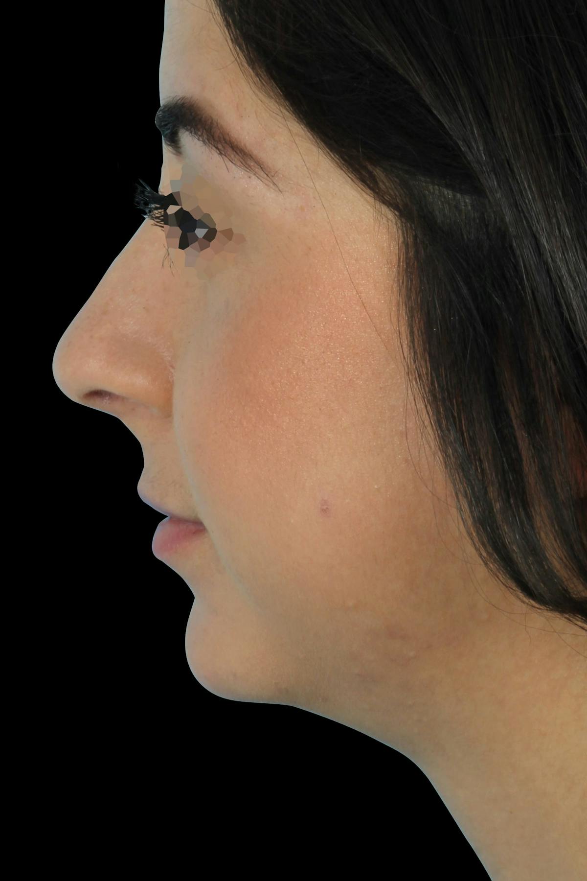 Before & Afters Before & After Gallery - Patient 412593 - Image 2