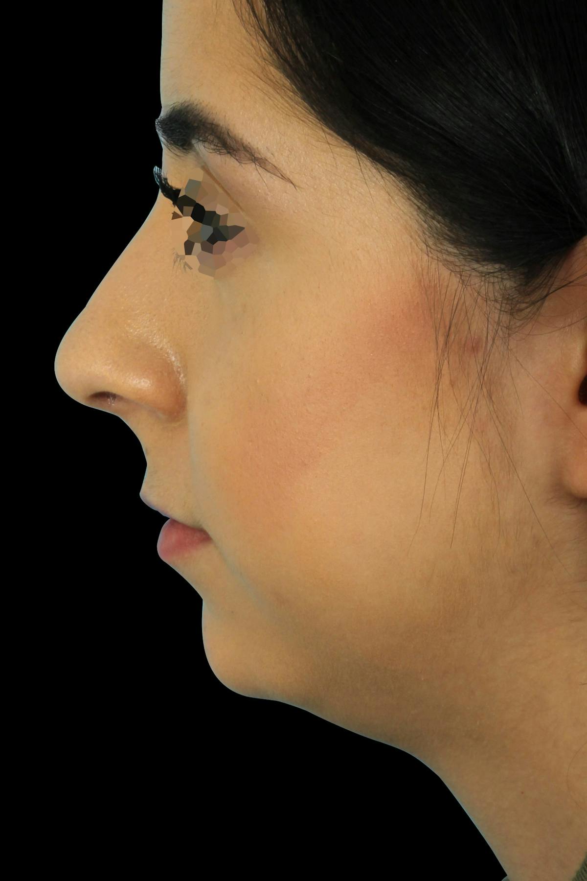 Before & Afters Before & After Gallery - Patient 412593 - Image 1