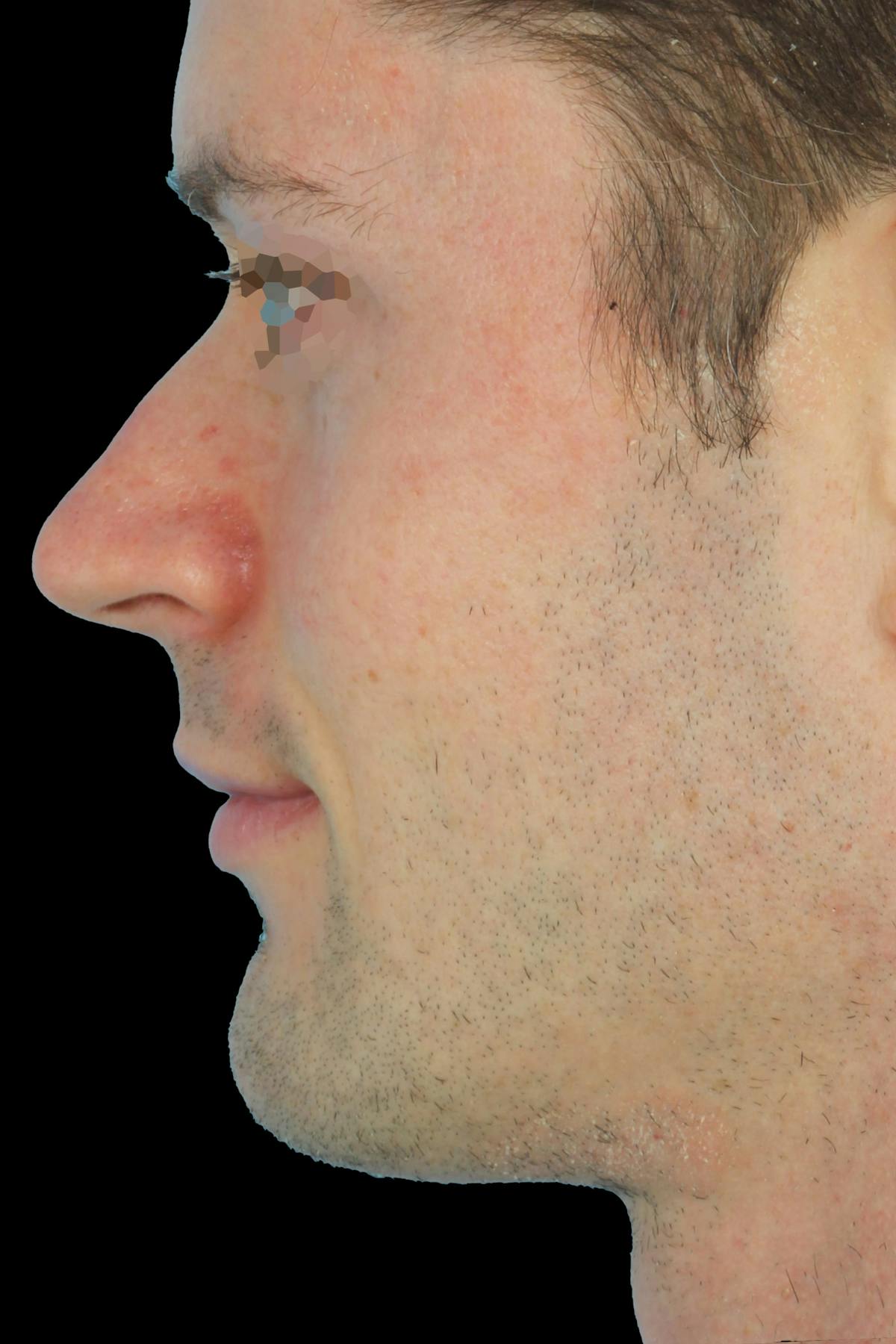 Before & Afters Before & After Gallery - Patient 114688 - Image 2