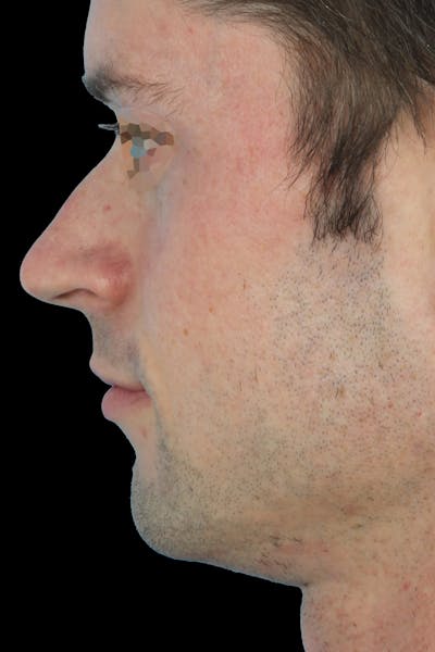 Before & Afters Before & After Gallery - Patient 114688 - Image 1