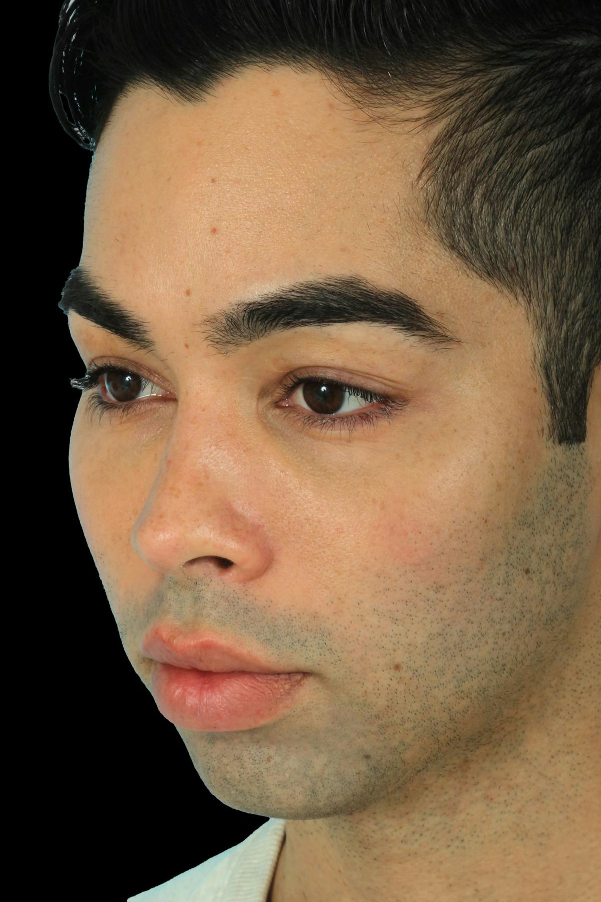 Before & Afters Before & After Gallery - Patient 129635 - Image 1