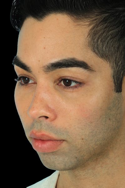 Before & Afters Before & After Gallery - Patient 129635 - Image 1