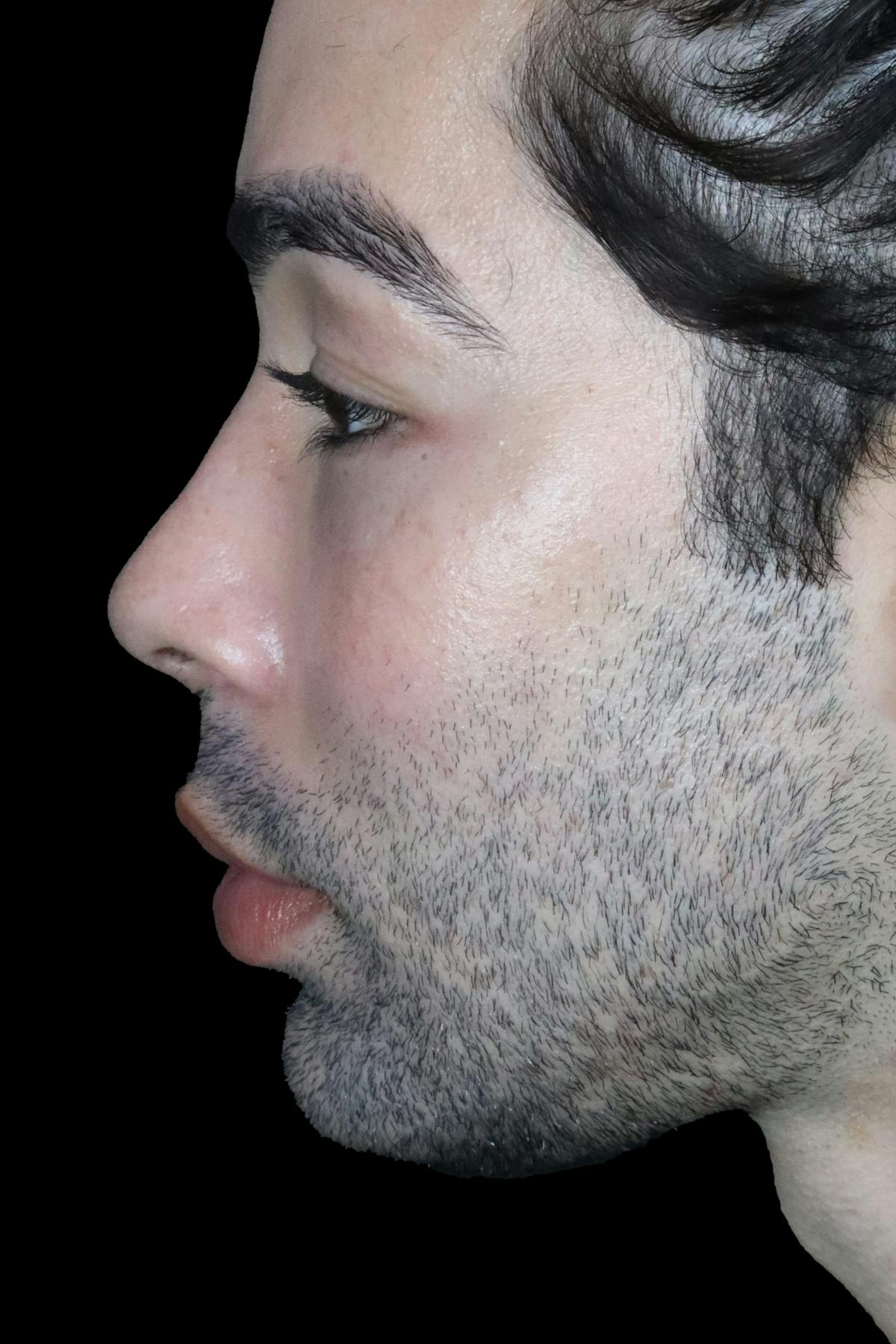 Before & Afters Before & After Gallery - Patient 129635 - Image 4