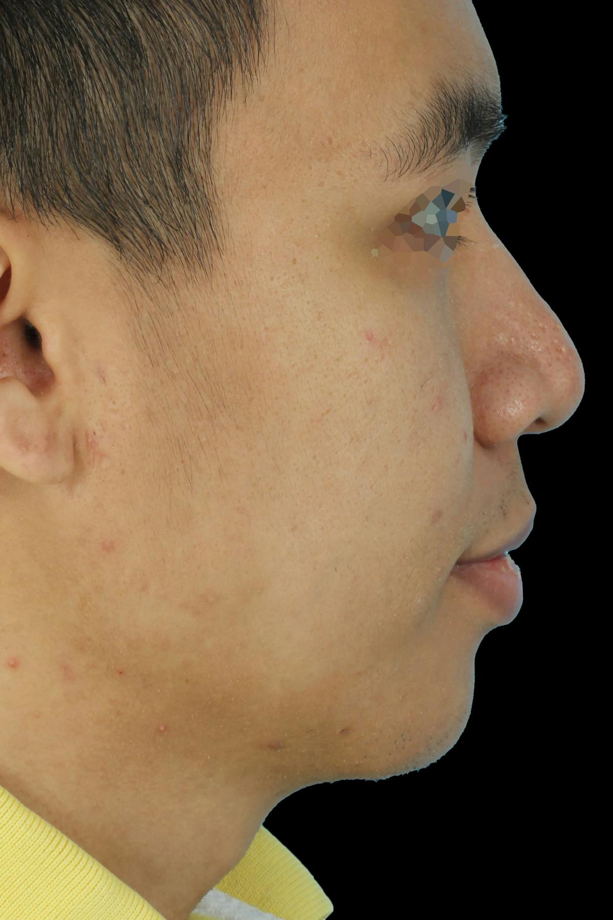 Before & Afters Before & After Gallery - Patient 347998 - Image 2