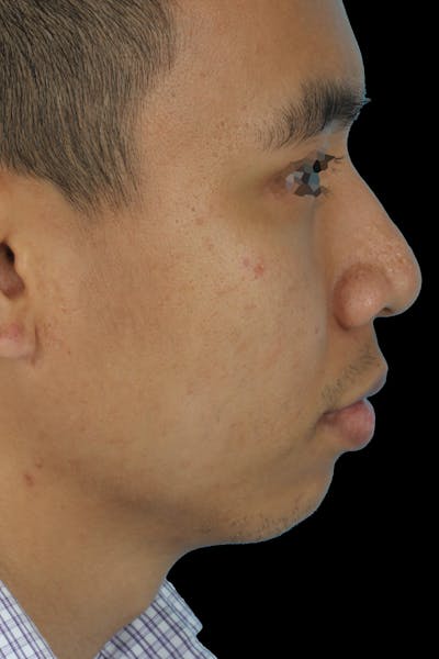 Before & Afters Before & After Gallery - Patient 347998 - Image 1