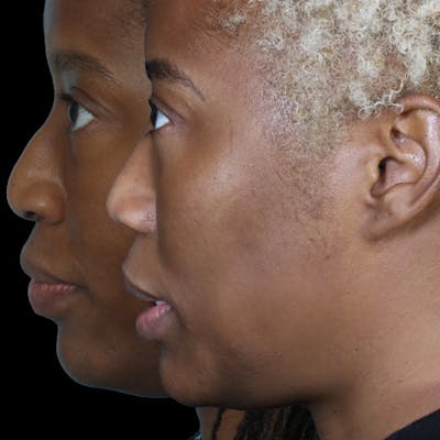 Before & Afters Before & After Gallery - Patient 339744 - Image 1