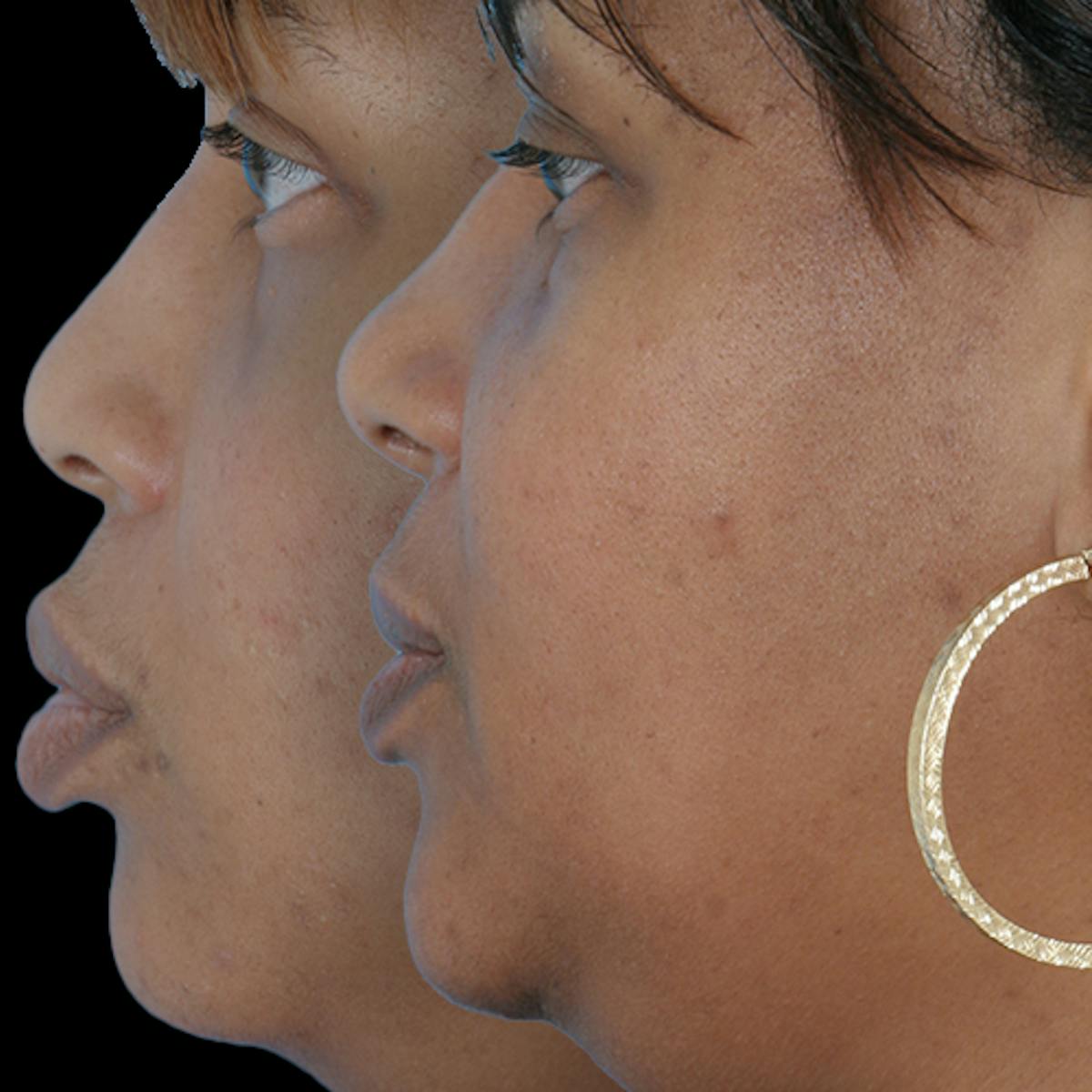 Before & Afters Before & After Gallery - Patient 238457 - Image 1