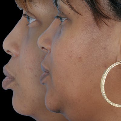 Before & Afters Before & After Gallery - Patient 238457 - Image 1