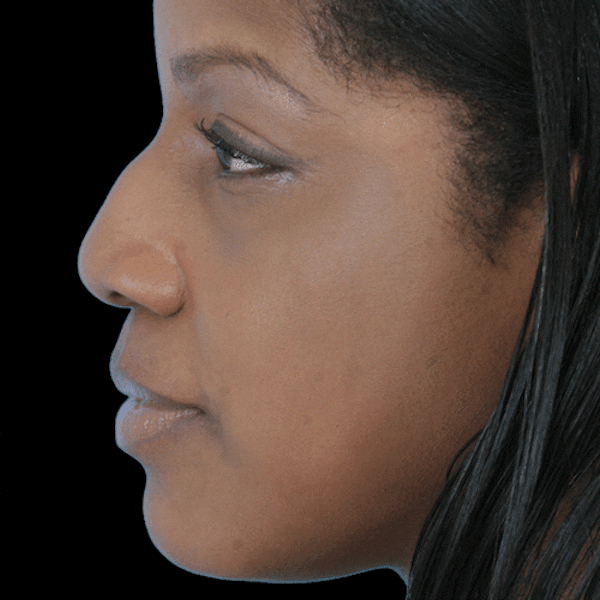 GIFs Before & After Gallery - Patient 278227 - Image 1