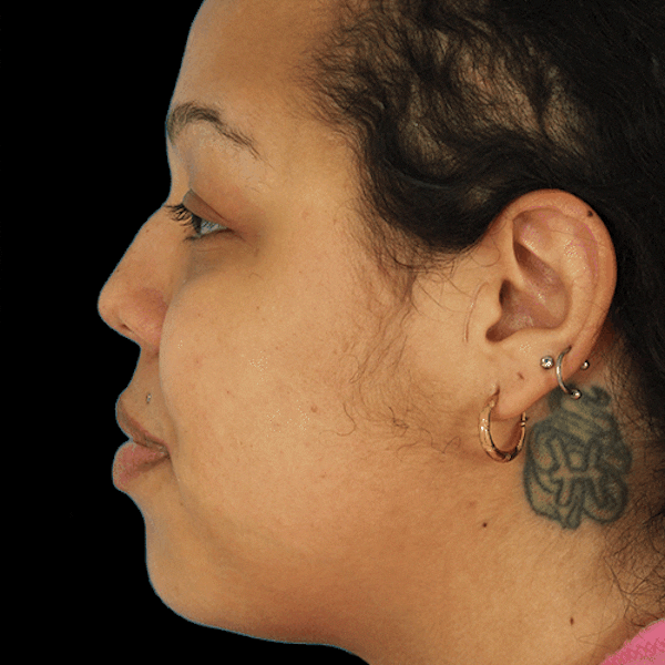 GIFs Before & After Gallery - Patient 778582 - Image 1