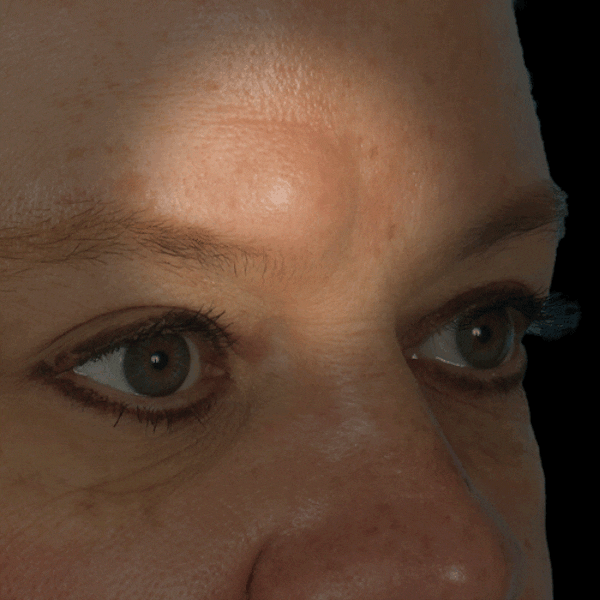 GIFs Before & After Gallery - Patient 118972 - Image 1