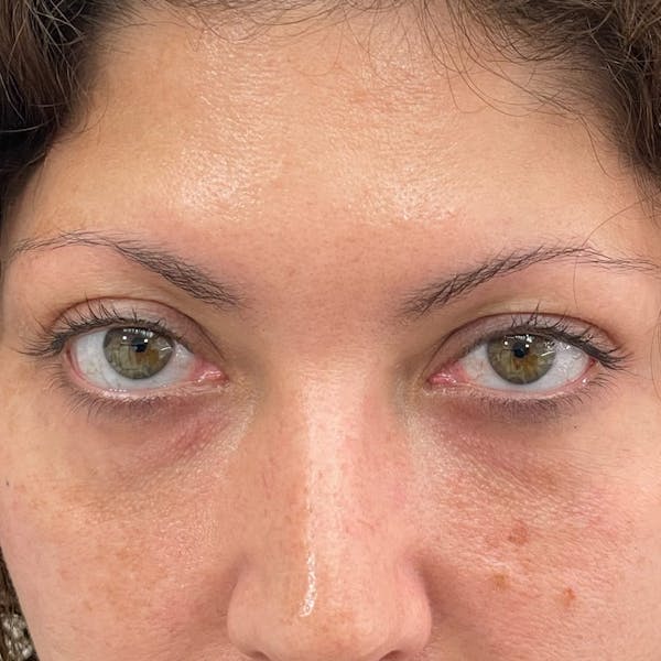 Under Eye Filler Before & After Gallery - Patient 407574 - Image 1