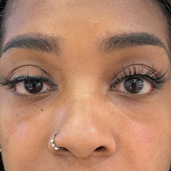 Under Eye Filler Before & After Gallery - Patient 118074 - Image 1