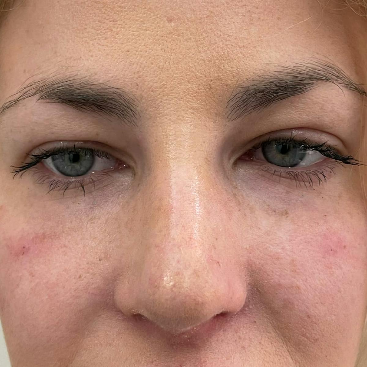 Under Eye Filler Before & After Gallery - Patient 336619 - Image 1