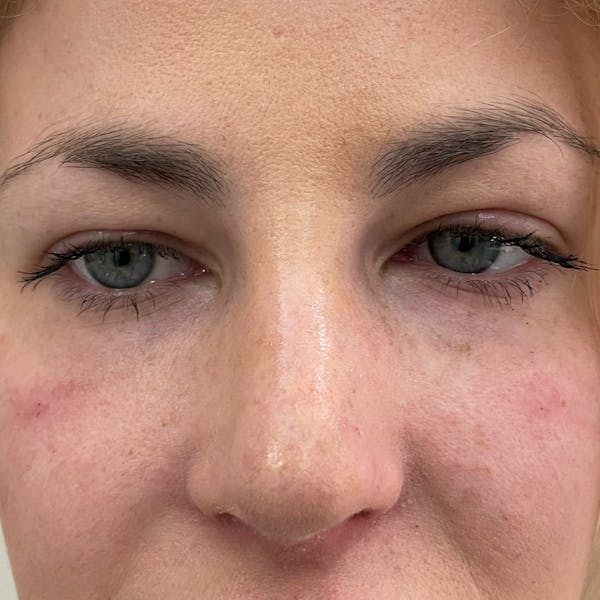 Under Eye Filler Before & After Gallery - Patient 336619 - Image 1