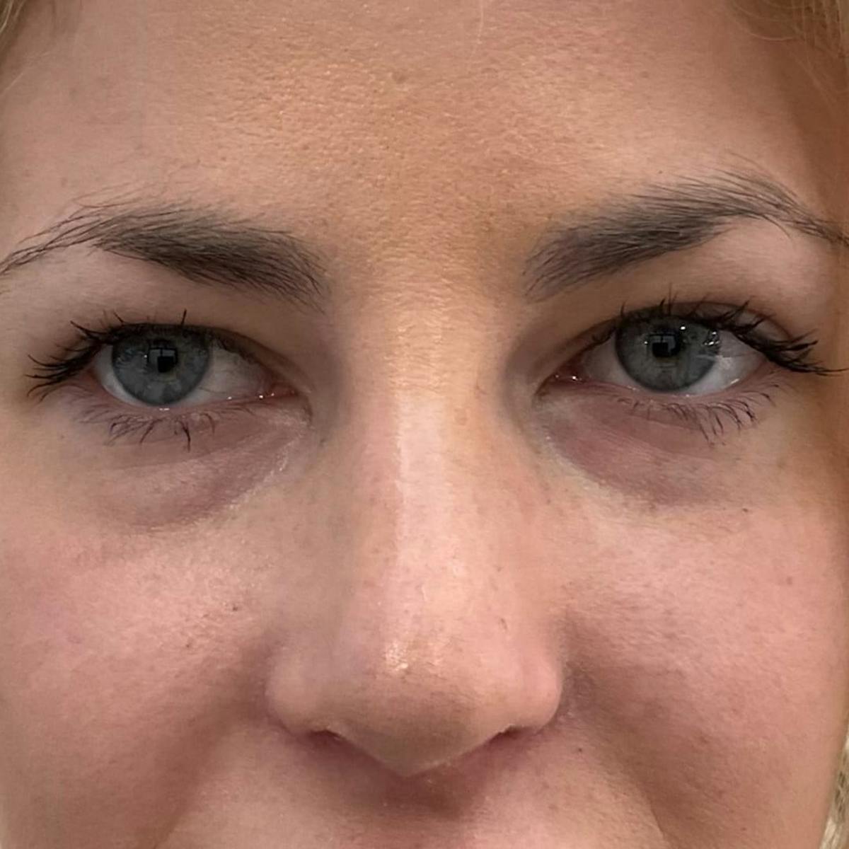 Under Eye Filler Before & After Gallery - Patient 336619 - Image 2