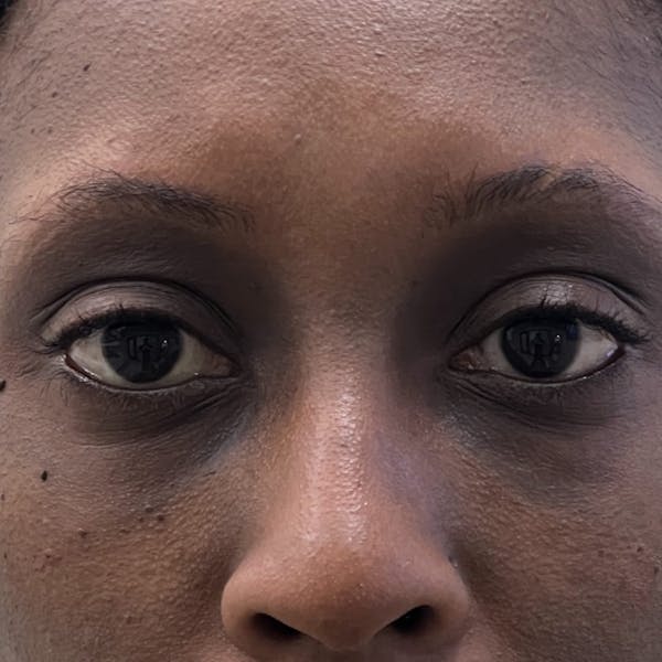 Under Eye Filler Before & After Gallery - Patient 343583 - Image 1
