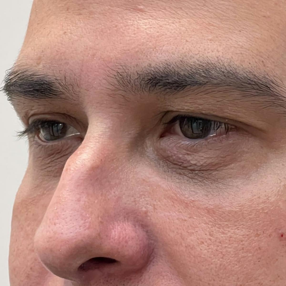 Under Eye Filler Before & After Gallery - Patient 187458 - Image 1