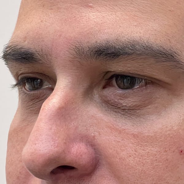 Under Eye Filler Before & After Gallery - Patient 187458 - Image 1