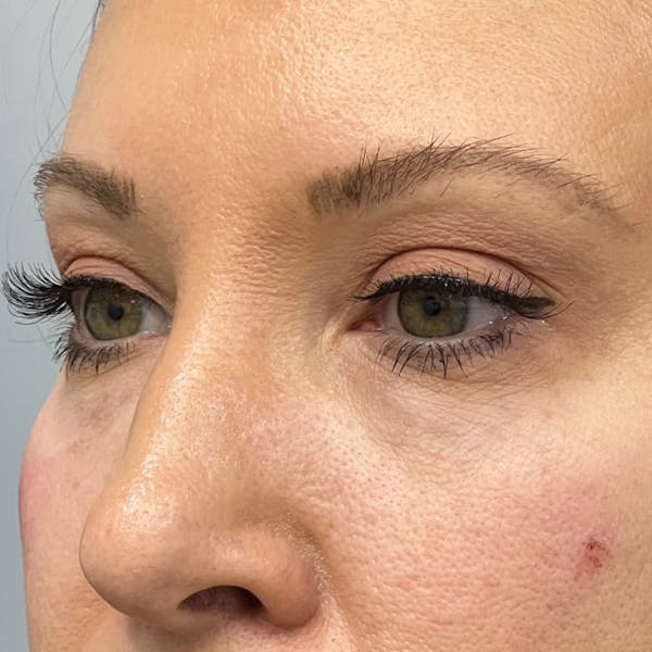 Under Eye Filler Before & After Gallery - Patient 300140 - Image 1