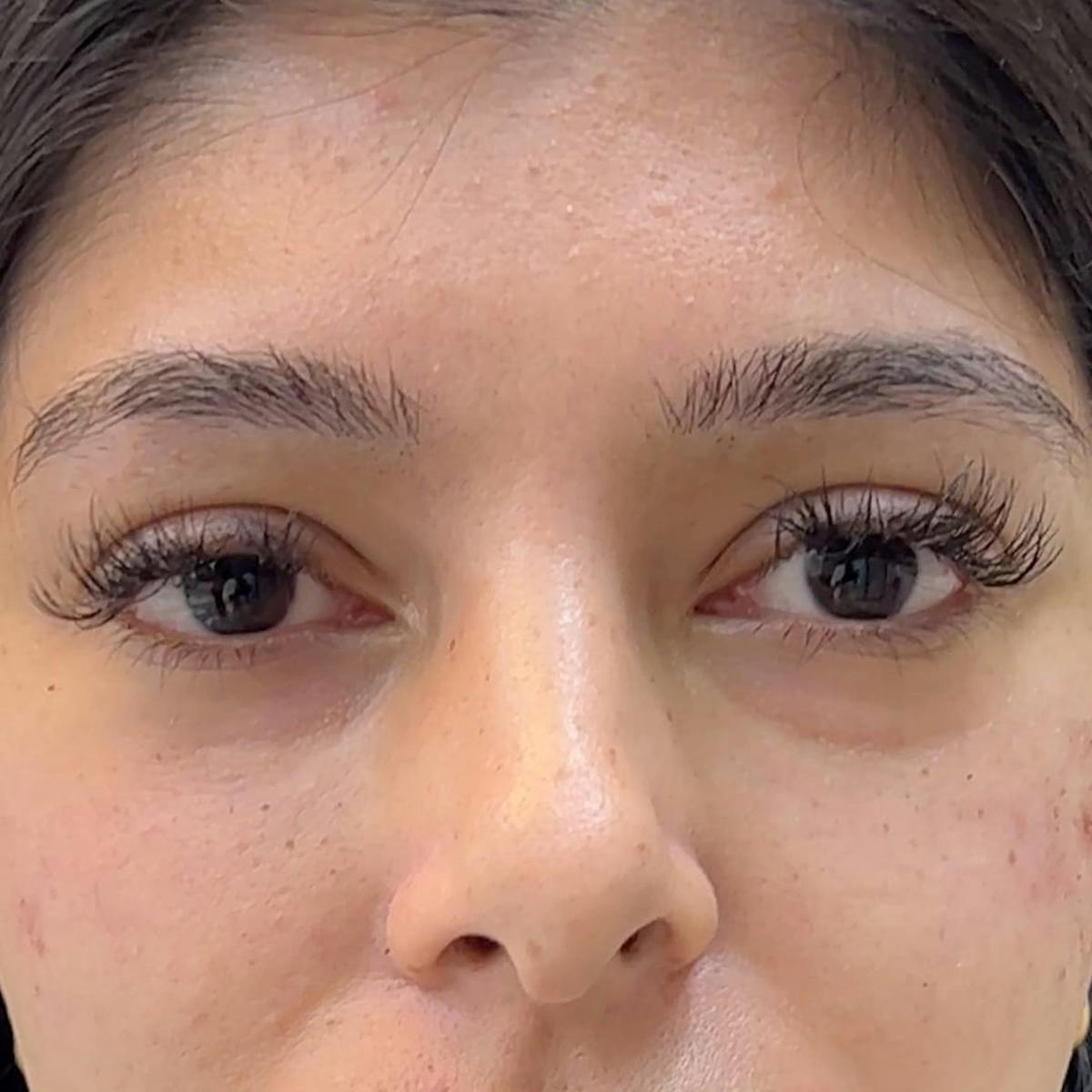 Under Eye Filler Before & After Gallery - Patient 207263 - Image 1