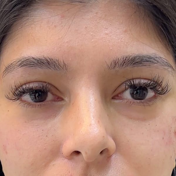 Under Eye Filler Before & After Gallery - Patient 207263 - Image 1