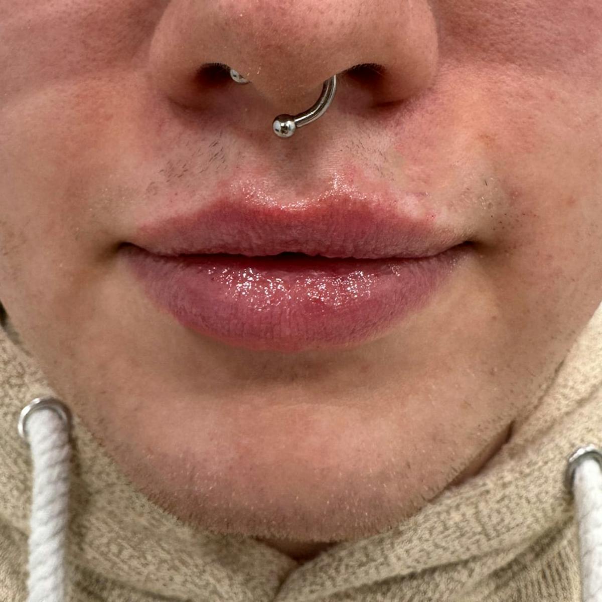 Lip Filler Before & After Gallery - Patient 361004 - Image 2