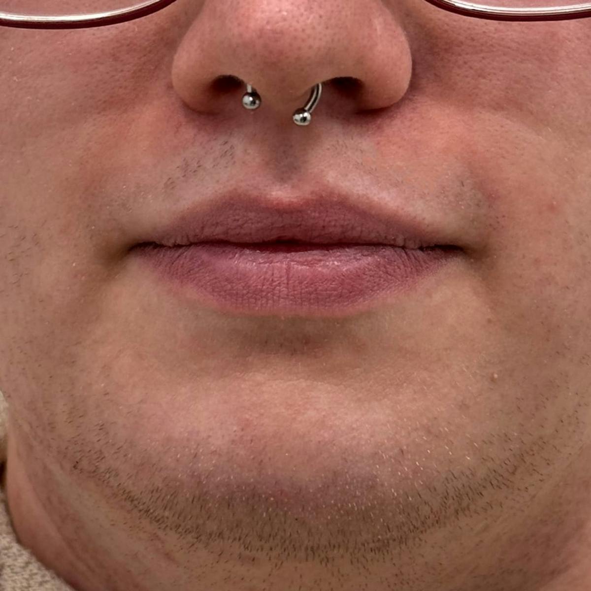 Lip Filler Before & After Gallery - Patient 361004 - Image 1