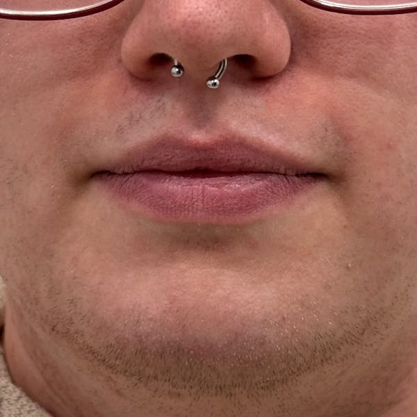 Lip Filler Before & After Gallery - Patient 361004 - Image 1