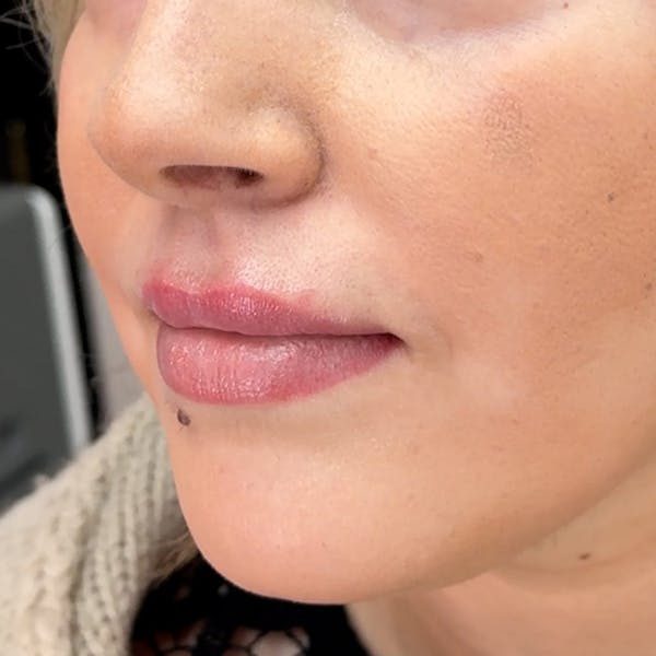 Lip Filler Before & After Gallery - Patient 224758 - Image 1