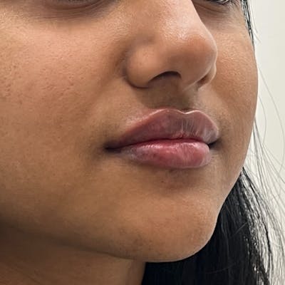 Lip Filler Before & After Gallery - Patient 902709 - Image 1