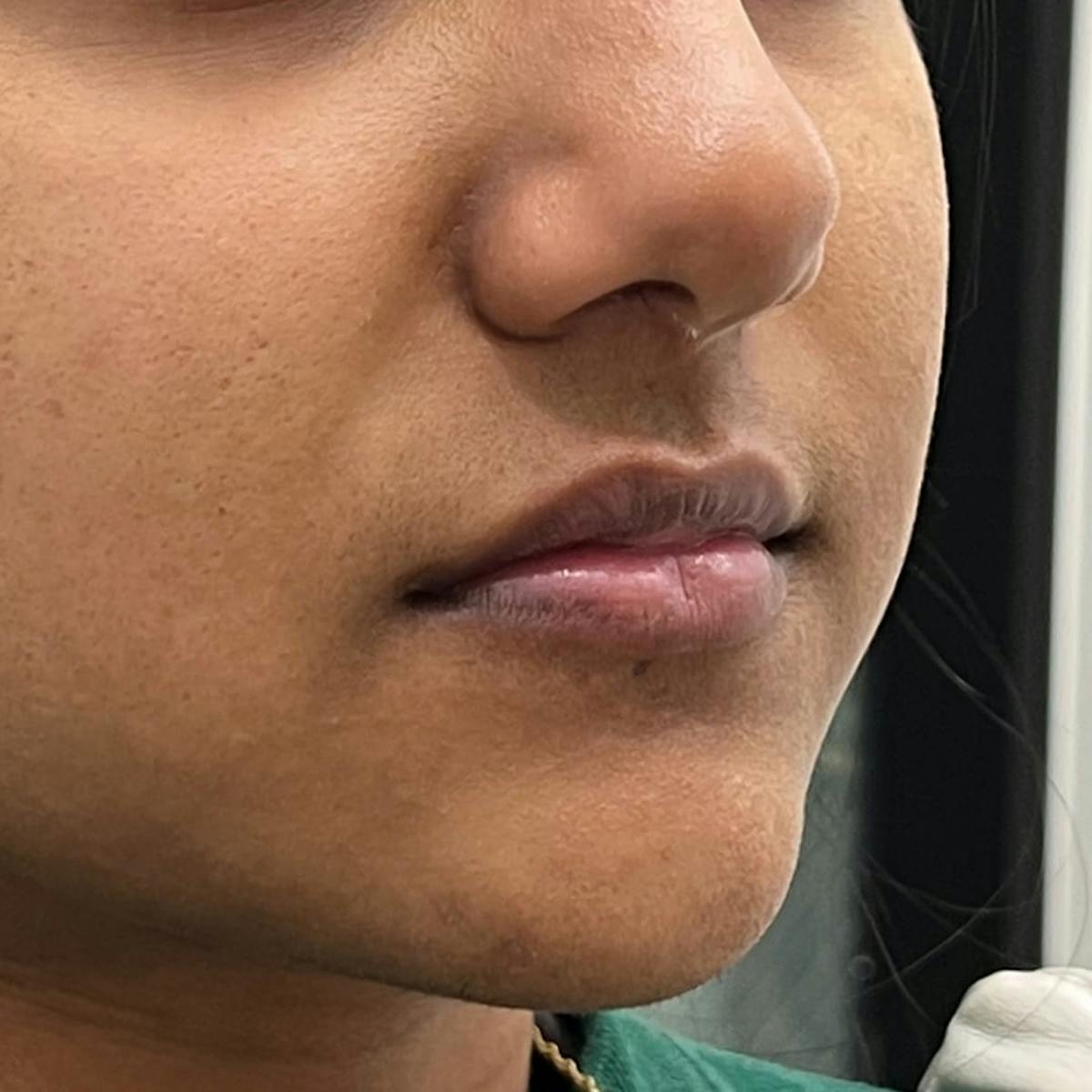 Lip Filler Before & After Gallery - Patient 902709 - Image 2