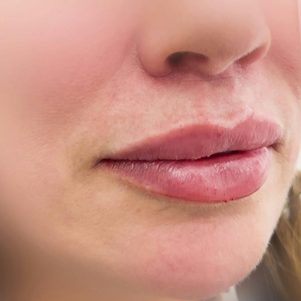 Lip Filler Before & After Gallery - Patient 105283 - Image 1