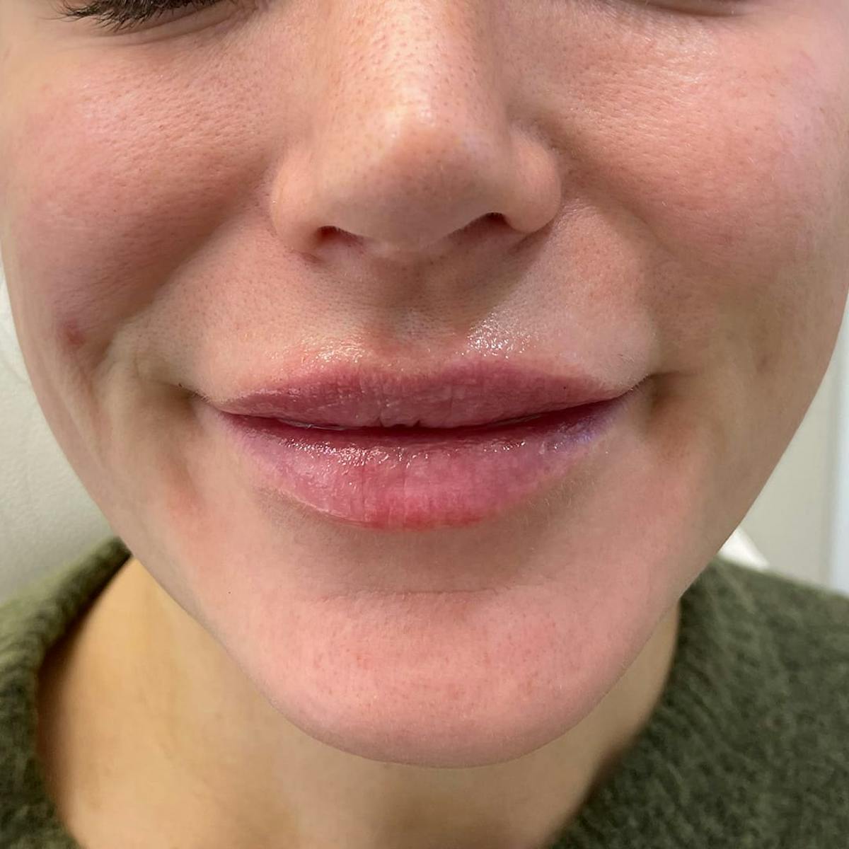 Lip Filler Before & After Gallery - Patient 365822 - Image 1